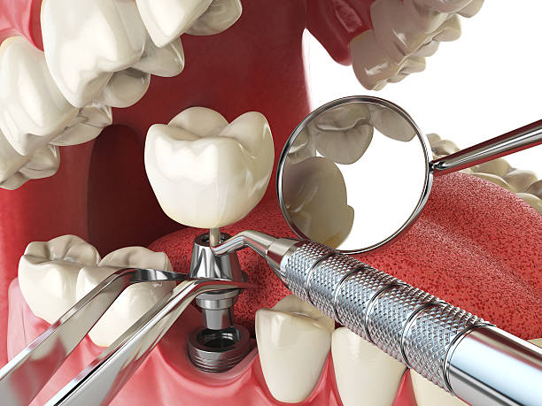 Best Lost Filling or Crown Replacement in Tillson, NY